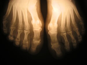 X-ray image of bones in human feet